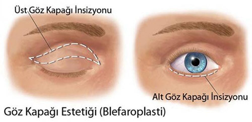 Ankara-Eyelid Aesthetics
